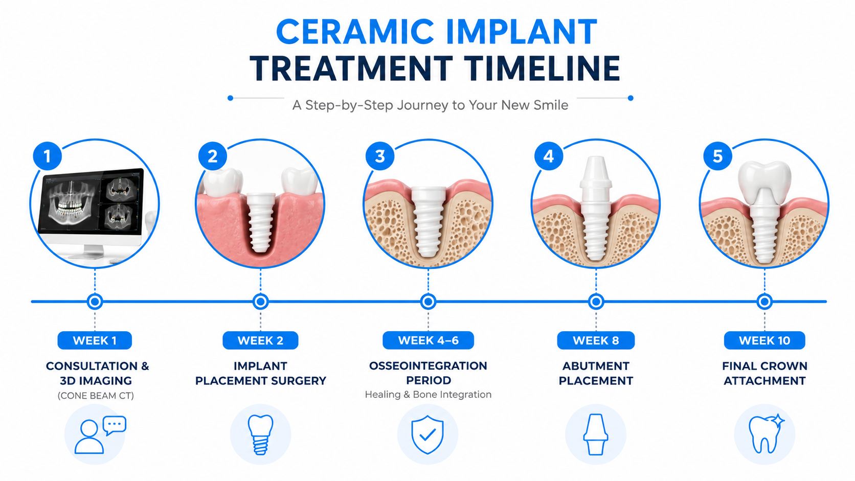An infographic showing the five-step timeline for the ceramic dental implant procedure from consultation to final crown.