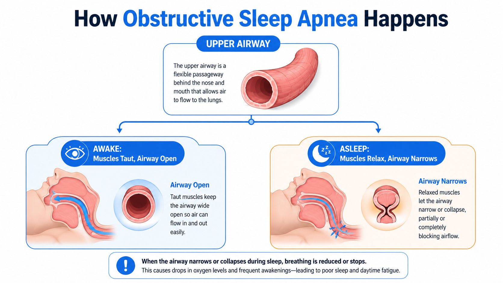 A diagram comparing an open airway while awake to a narrowed or collapsed airway while asleep in sleep apnea.
