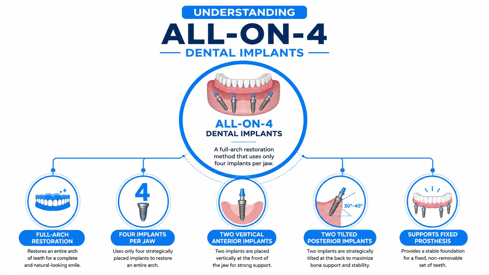 A diagram explaining the All-on-4 dental implant procedure using four implants for a full-arch restoration.