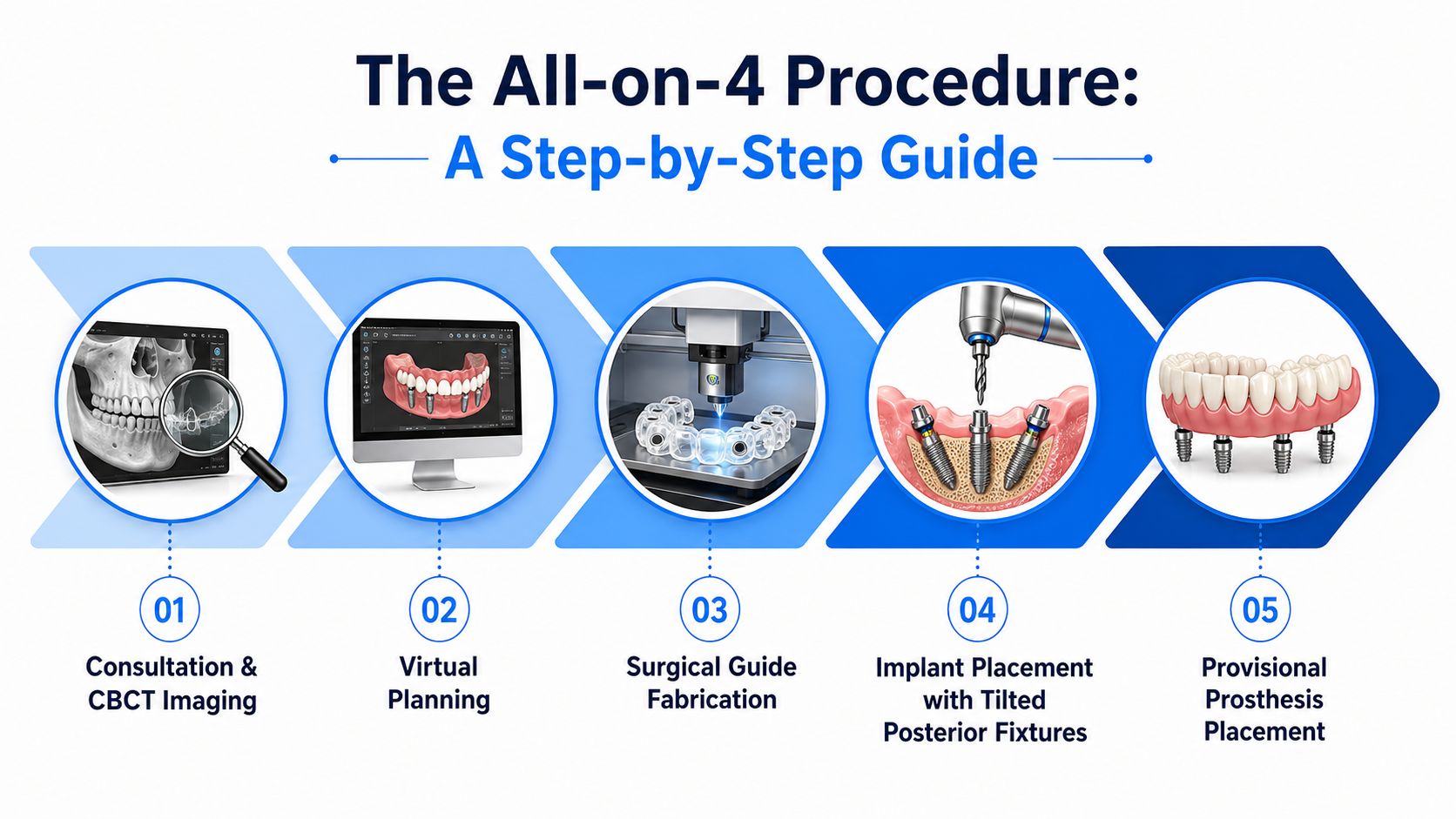 A five-step infographic showing the All-on-4 dental implant procedure from CBCT imaging to final prosthesis placement.