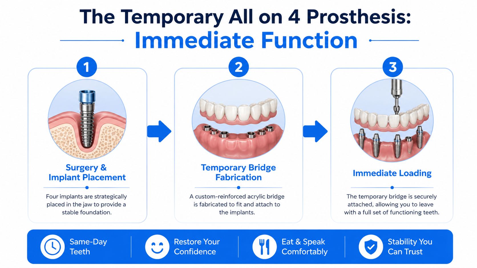 A diagram illustrating the three-step All-on-4 dental implant procedure for receiving temporary immediate function teeth.