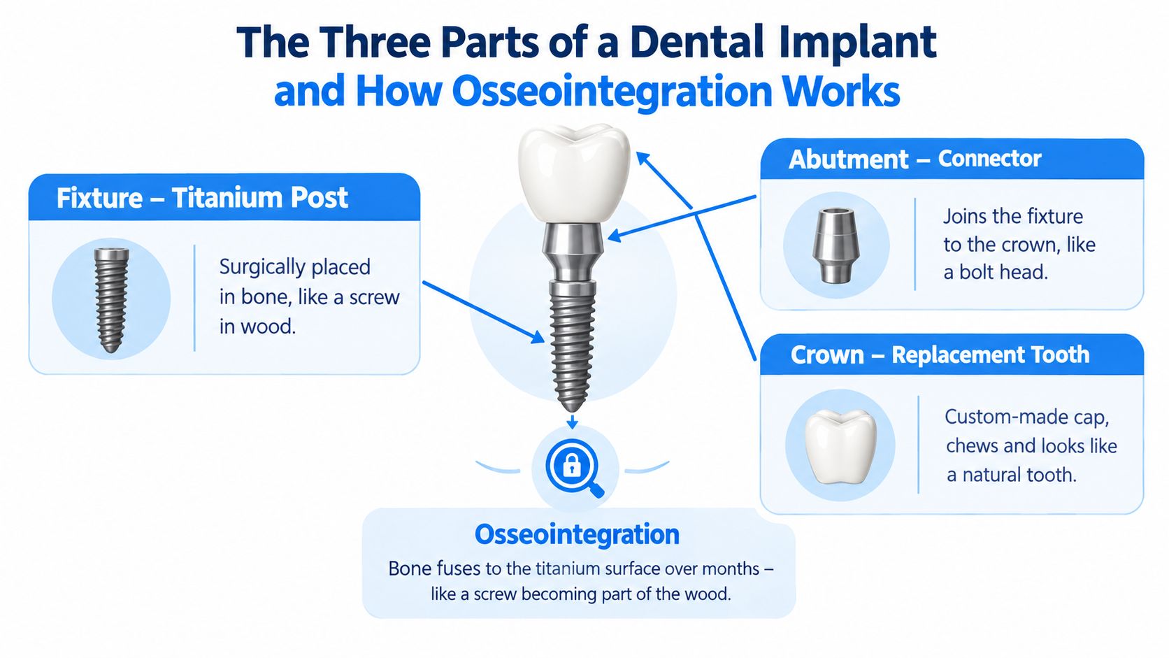 An infographic detailing the three components of a dental implant and the biological process of osseointegration.