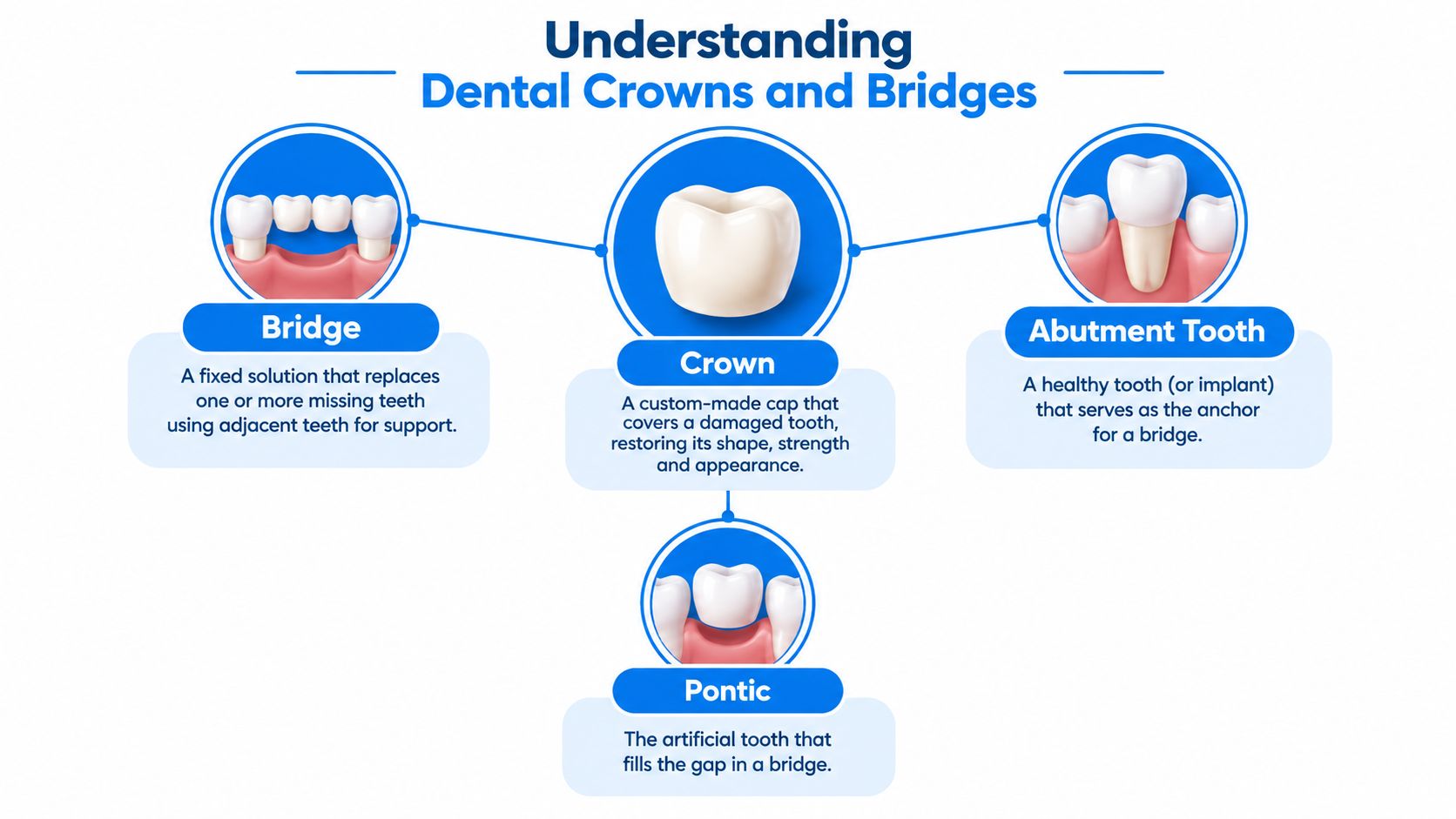 An educational infographic explaining the functions of dental crowns, bridges, abutment teeth, and pontics in dentistry.