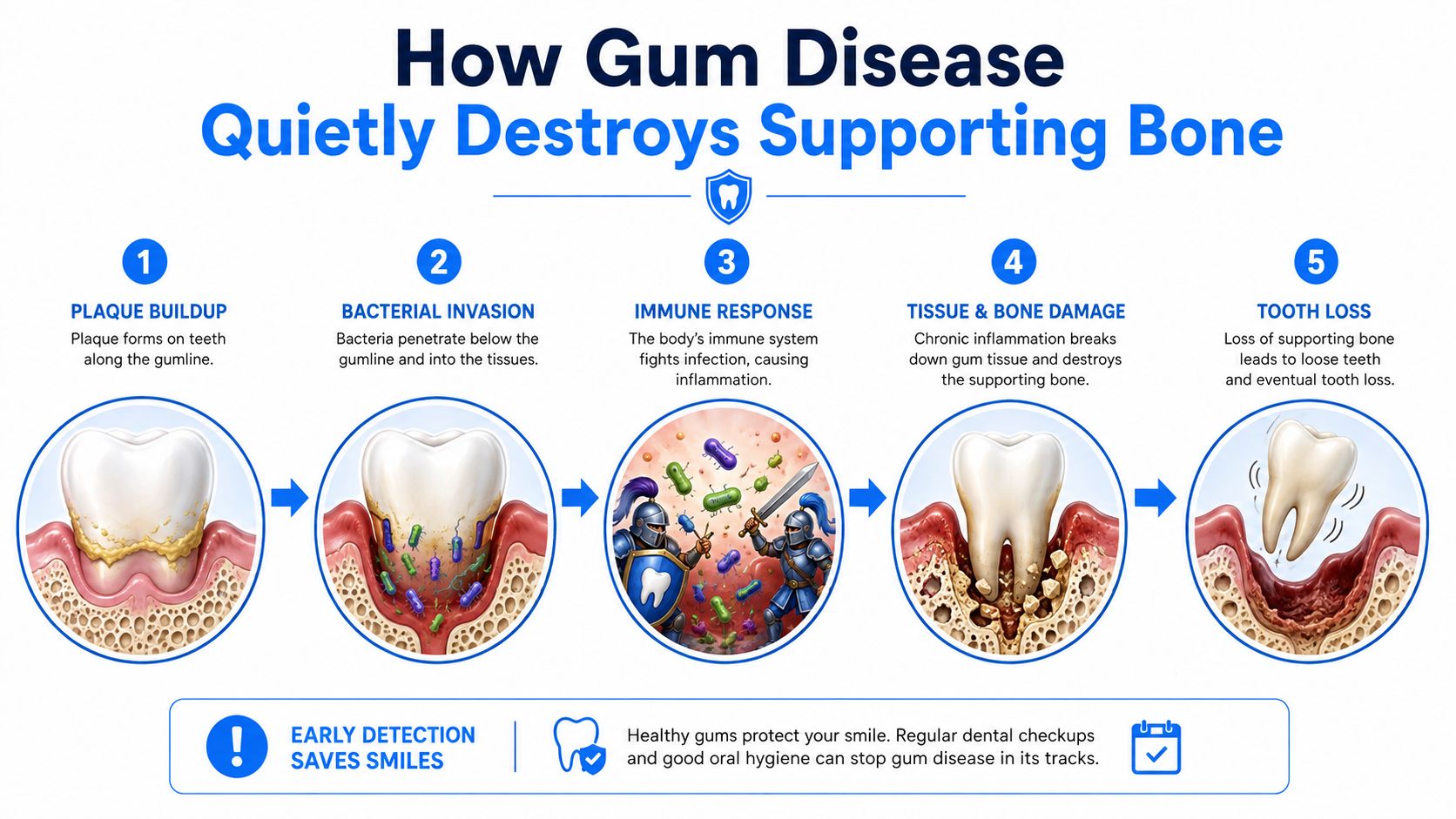A five-step infographic showing how gum disease progresses from plaque buildup to eventual tooth loss.